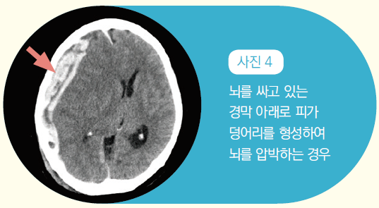사진 4 -뇌를 싸고 있는 경막 아래로 피가 덩어리를 형성하여 뇌를 압박하는 경우