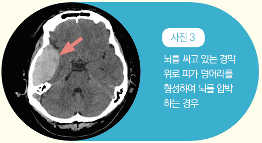 사진 3 -뇌를 싸고 있는 경막 위로 피가 덩어리를 형성하여 뇌를 압박하는 경우