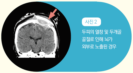 사진 2 -두피의 열창 및 두개골 골절로 인해 뇌가 외부로 노출된 경우