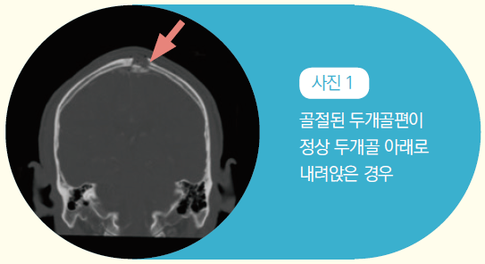 사진 1 -골절된 두개골편이 정상 두개골 아래로 내려앉은 경우