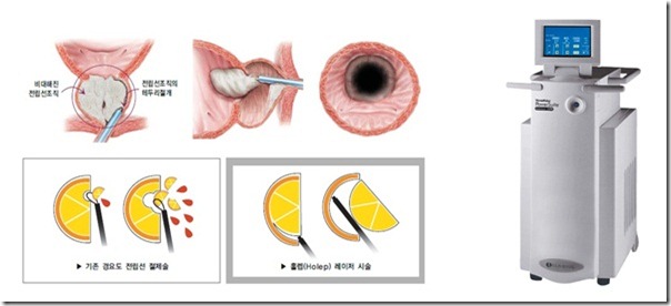 홀렙수술모습1