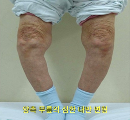 양측 무릎의 심한 내반 변형 사례